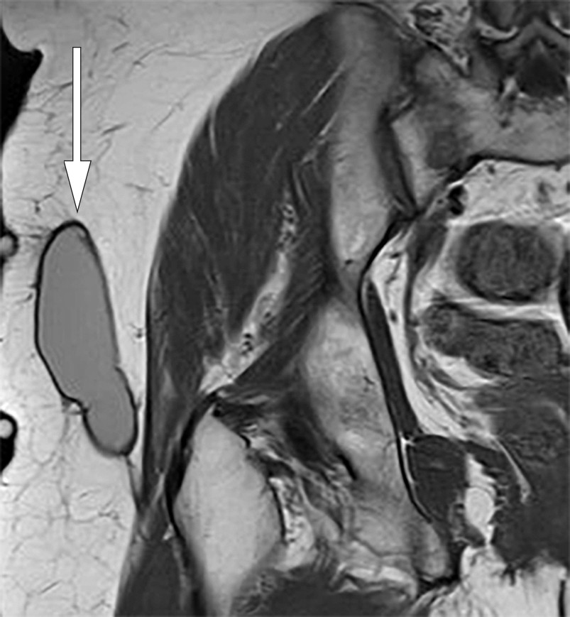 Figure 1 Coronal T1-weighted MRI of right hip. Well-defined, elongated, lenticular structure with homogeneous intermediate…