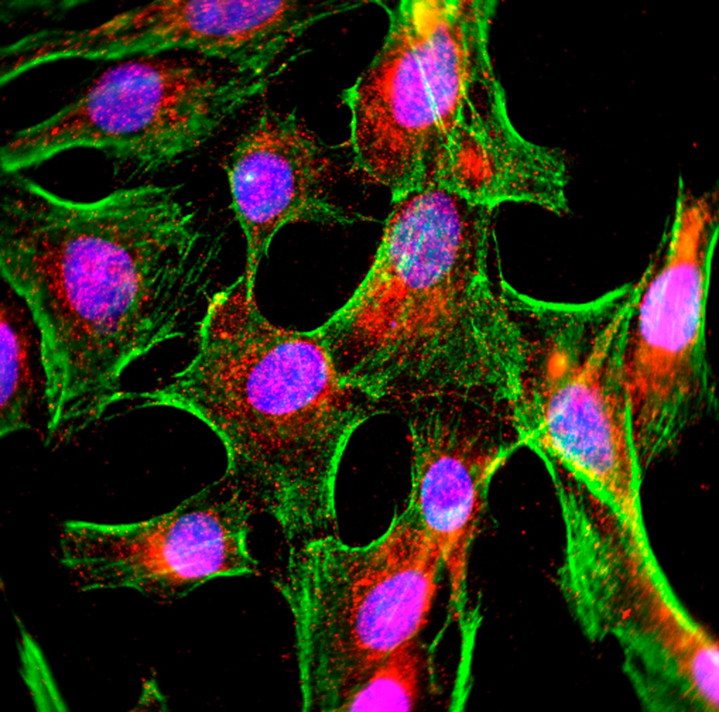 Dyrkede gliaceller som uttrykker tau-protein (r&oslash;dt). Bl&aring;tt = cellekjerner, gr&oslash;nt = aktinfibre. Akkumulering av tau i&hellip;