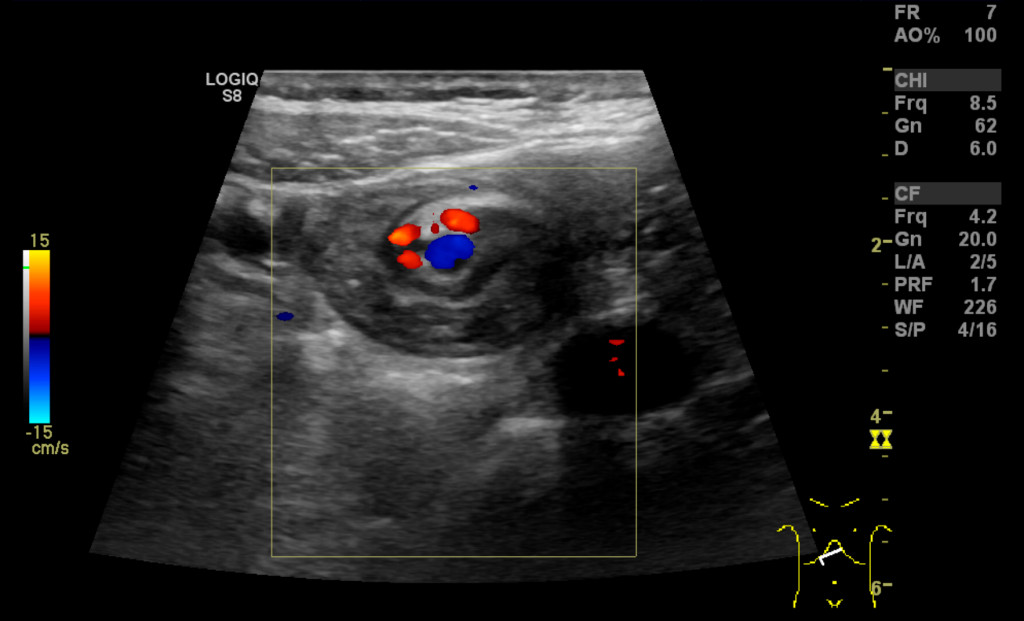 Figure 2 Ultrasound. Whirl sign involving mesenteric vessels and loops of small intestine. The superior mesenteric artery …