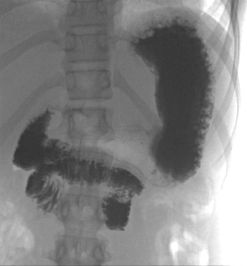 Figure 3 Upper gastrointestinal series (x-ray of oesophagus, stomach and duodenum). Contrast can be seen in the stomach and…