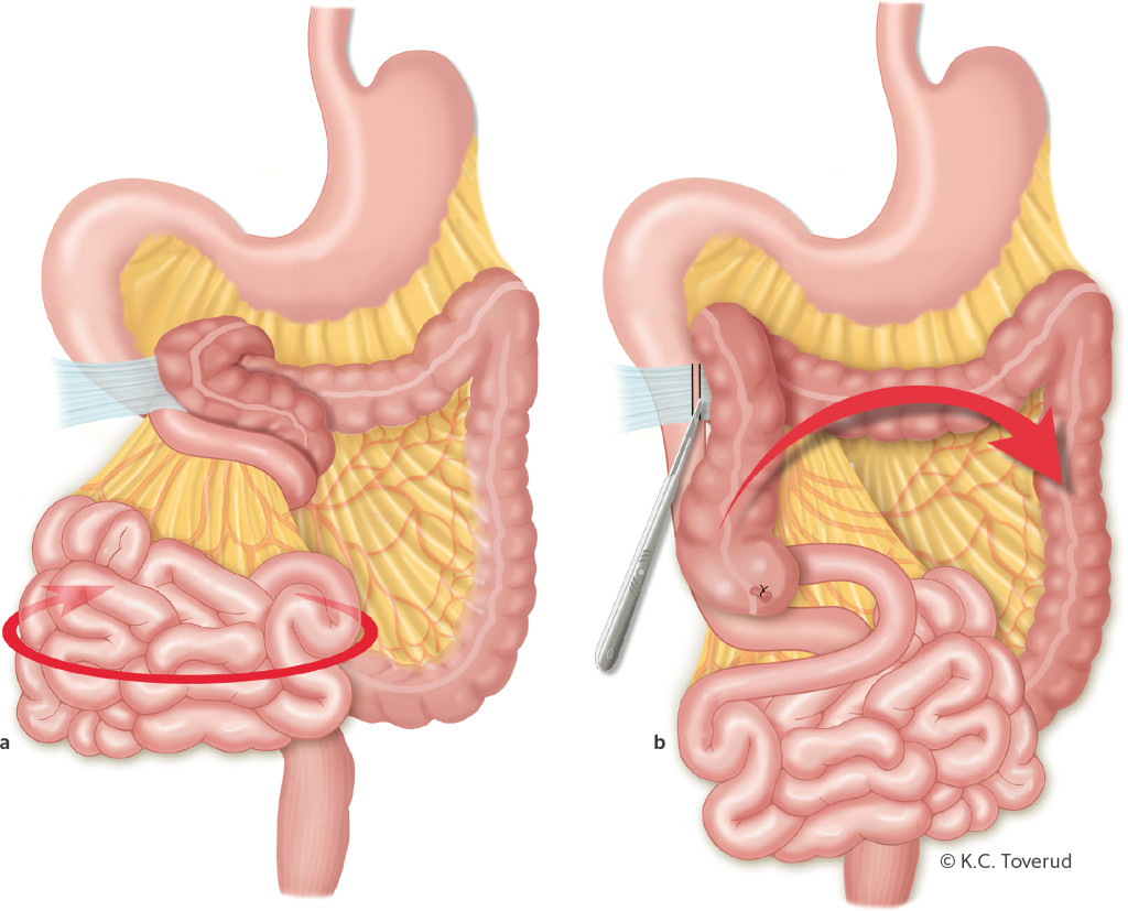 Figure 4 a) Midgut volvulus due to congenital malrotation and duodenal obstruction due to congenital Ladd's bands. Volvulus…