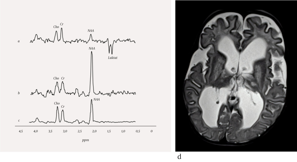 Figure 1 MR spectra from a) a patient with Leigh syndrome, b) a patient with Canavan disease and c) a healthy person, and d)…