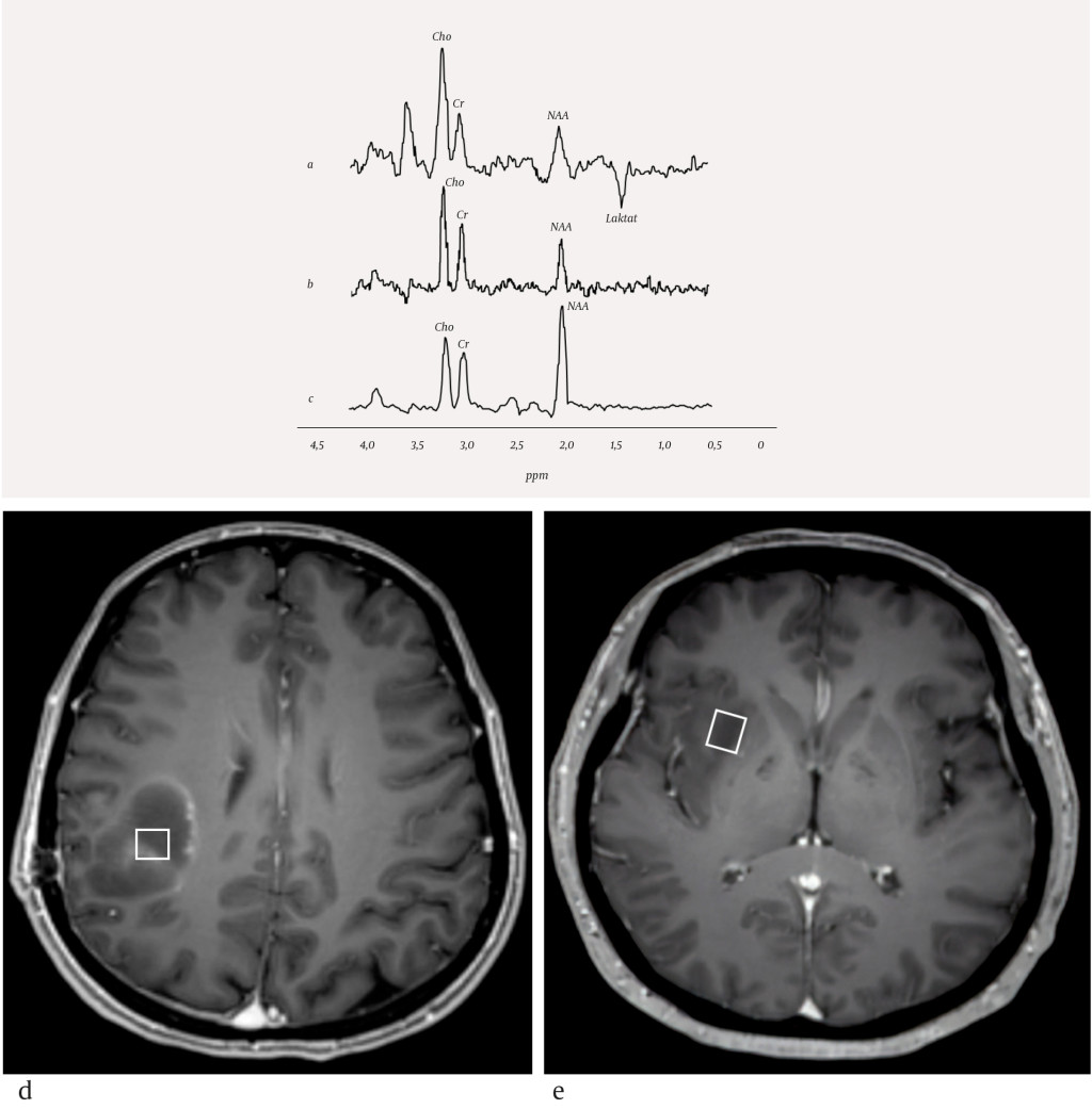 Figure 2 MR spectra of a) high grade glioma, b) low grade glioma and c) a healthy person, and T1-weighted MRI showing volume…