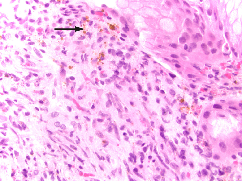 Figure 2 Biopsy from the gastric mucosa with capillary proliferation, extravasated erythrocytes and haemosiderin (arrow)…