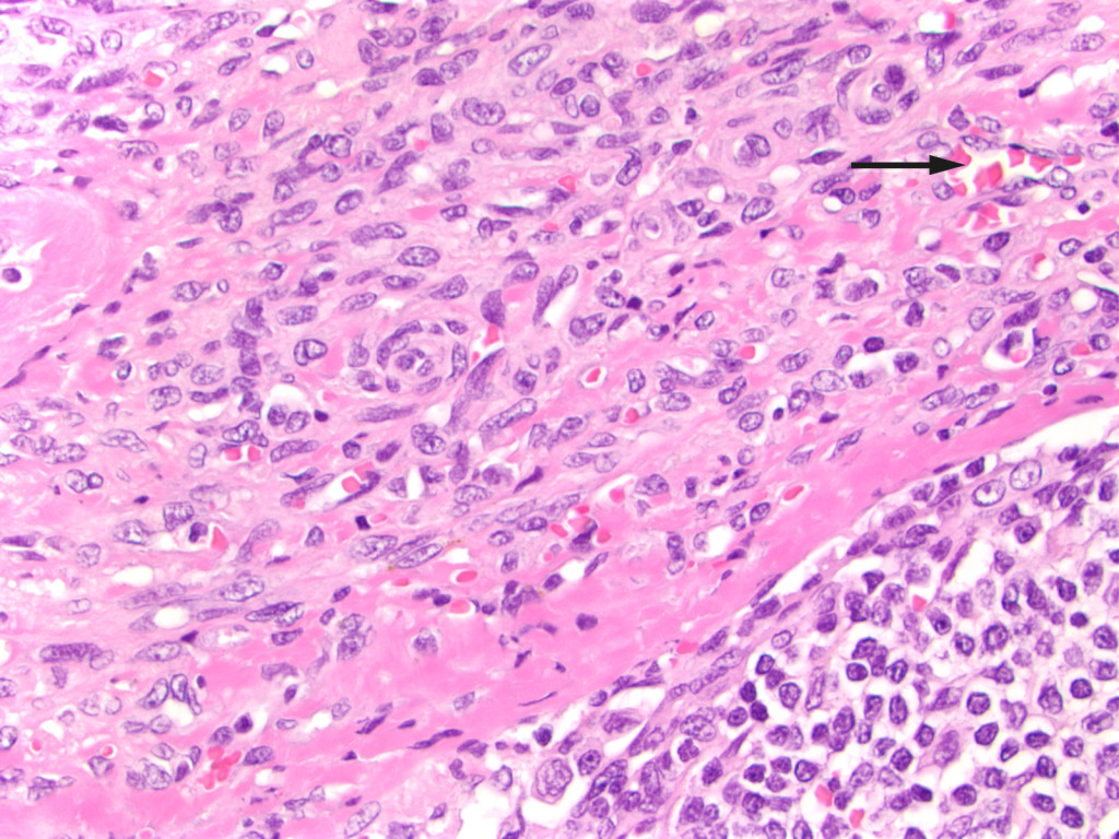 Figure 3 Lymph node with capillary proliferation. Spindle cells and extravasated erythrocytes in the capsule (arrow). Normal…