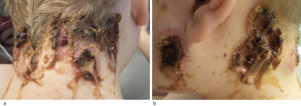 Figure 1 Ulcerations of the neck (a) and preauricularly (b) on admission. There was copious, purulent secretion. The edges…