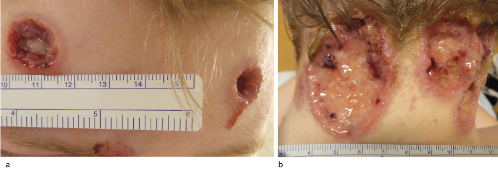 Figure 2 Ulcerations on the forehead (a) and neck (b) following wound care on day 4. The wound edges were moderately…