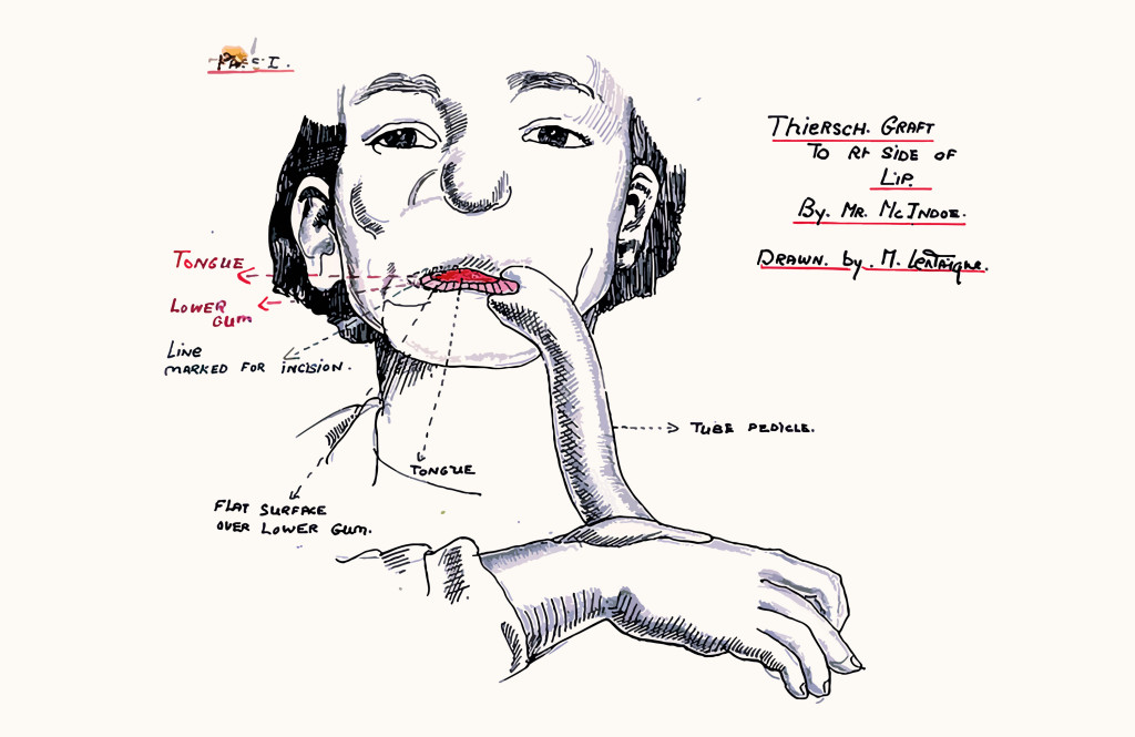 Figur 1 Illustrasjon av en avstandslapp (tube pedicle) tegnet av Mollie Lentaigne – en ung, britisk kvinne som var ansatt på…