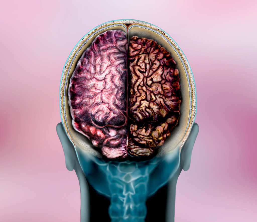 Frisk hjernehemisf&aelig;re (til venstre) sammenlignet med en hemisf&aelig;re p&aring;virket av Alzheimers sykdom (til h&oslash;yre). Illustrasjon:&hellip;