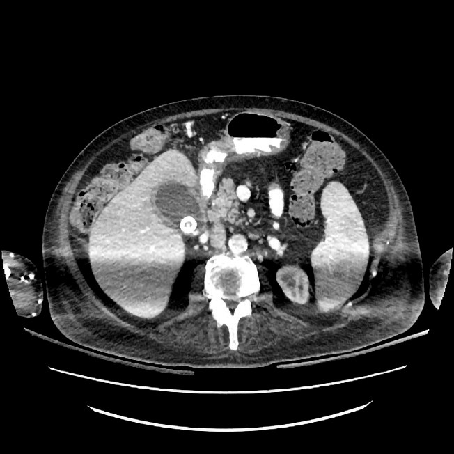 Figure 2 CT abdomen showing distended gallbladder with marked thickening of the wall, a focal response in surrounding&hellip;