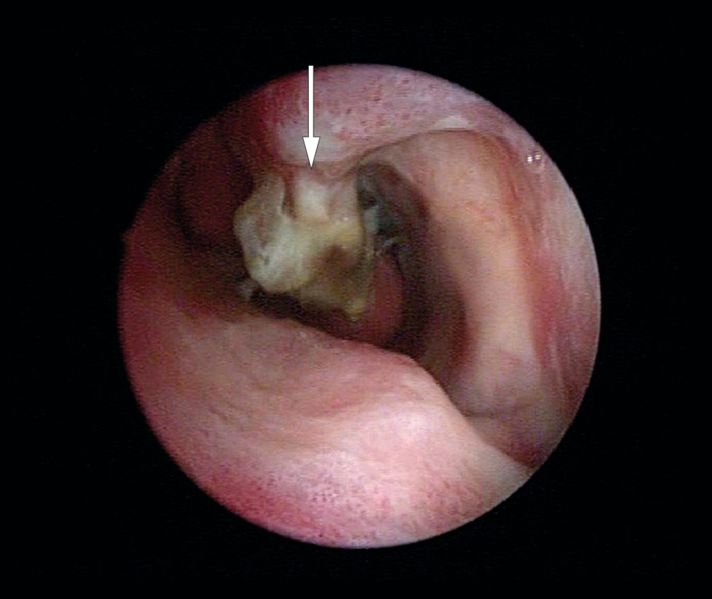Figure 1 Patient 1 at the time of diagnosis of osteomyelitis. The image shows a pus-covered and necrotic inferior turbinate …