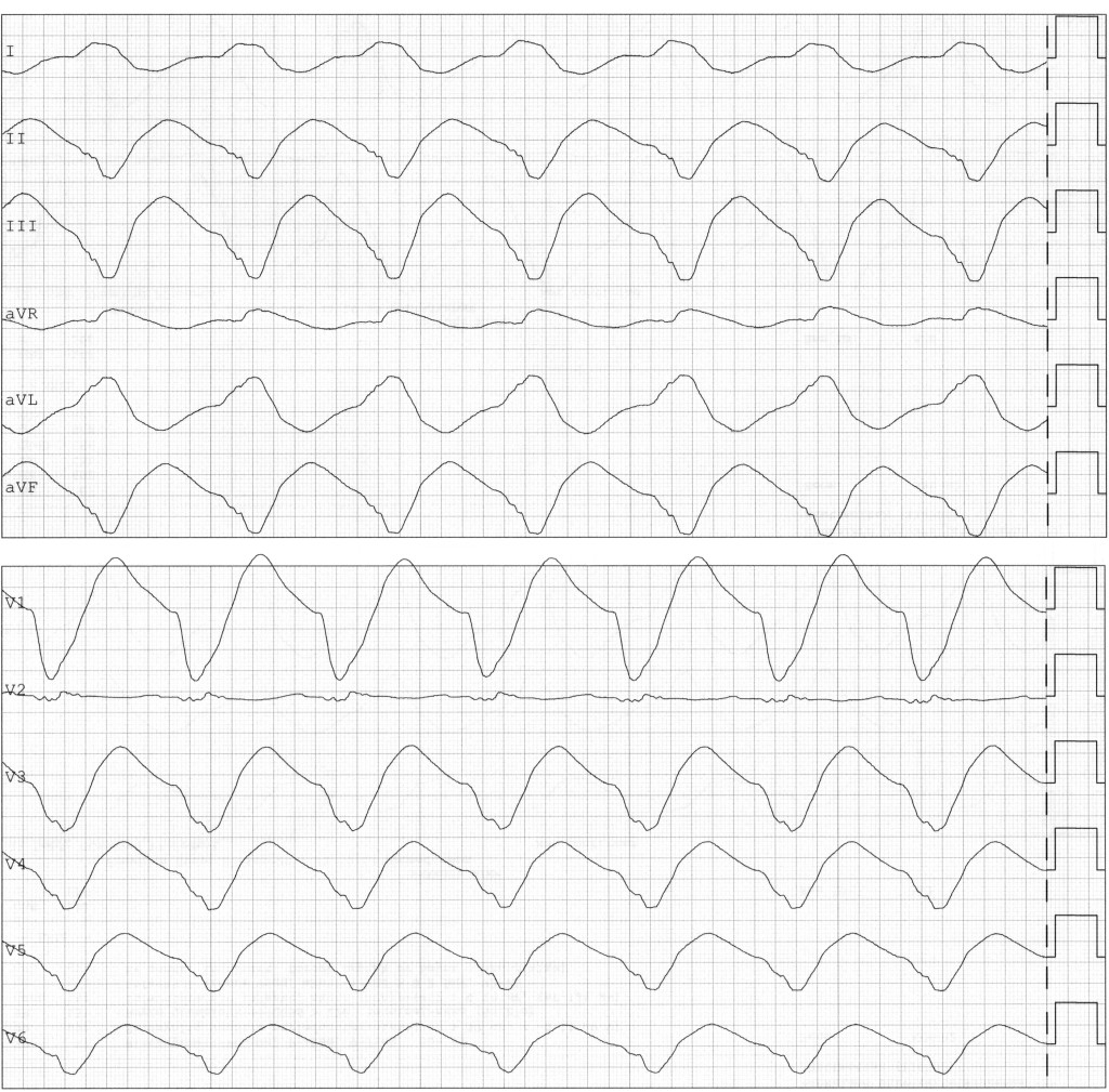 Figure 1 ECG from day 1 shows a broad complex rhythm with QRS width greater than 380 ms and diffuse ST-T wave changes. Heart…