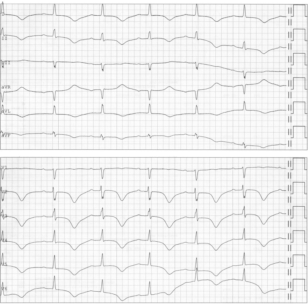 Figure 3 ECG from day 11 showing sinus rhythm but new-onset T-wave inversion in standard leads I, II, avL and aVF and in…