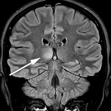 Figure 2 Right thalamic lesion on coronal MRI with FLAIR (fluid-attenuated inversion recovery).