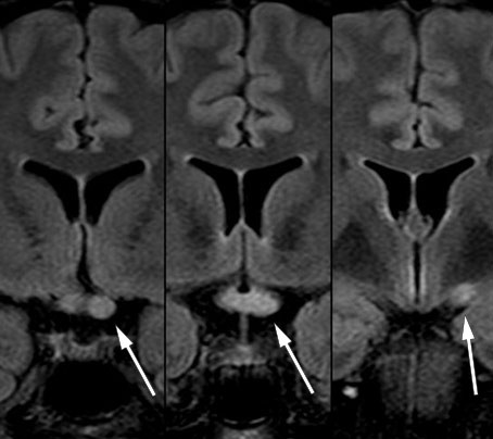 Figure 3 Coronal FLAIR-MRI series with a longitudinally extensive lesion in the left optic nerve, through the optic chiasm…