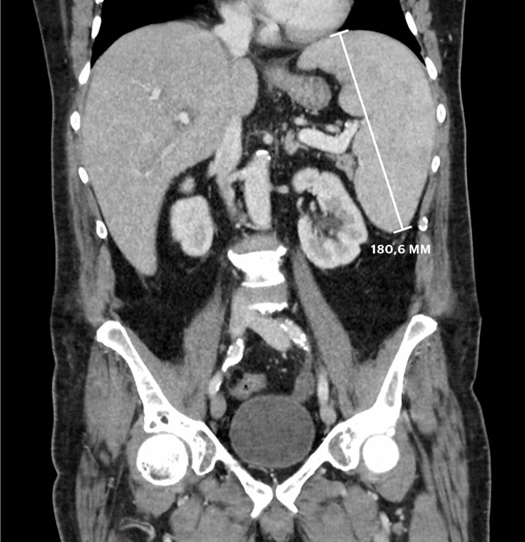 Figure 1 CT taken on day 13 showed an enlarged spleen (18 cm) and liver.