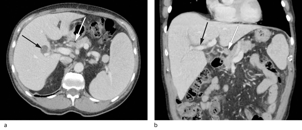 Figure 1 a) Axial CT of the upper abdomen with enlarged spleen and accessory spleen, prominent hepatic hilar lymph glands …