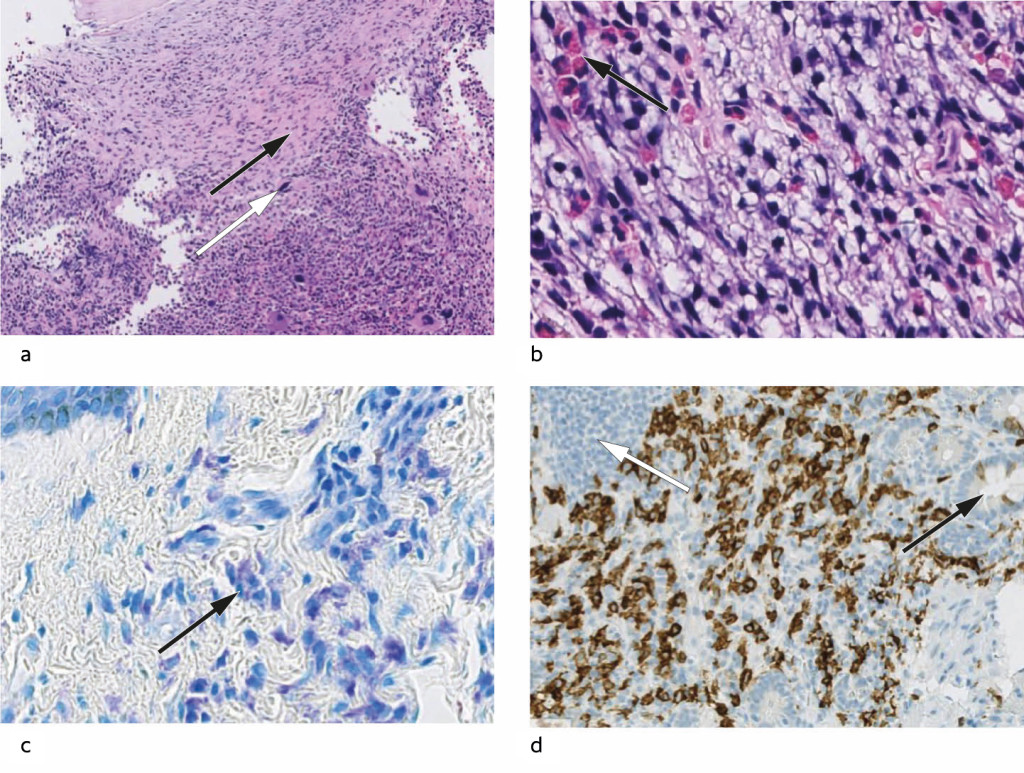 Figure 2 a) Bone marrow biopsy. The marrow is maximally cell rich. In the upper half, infiltrating mast cells can be seen in…