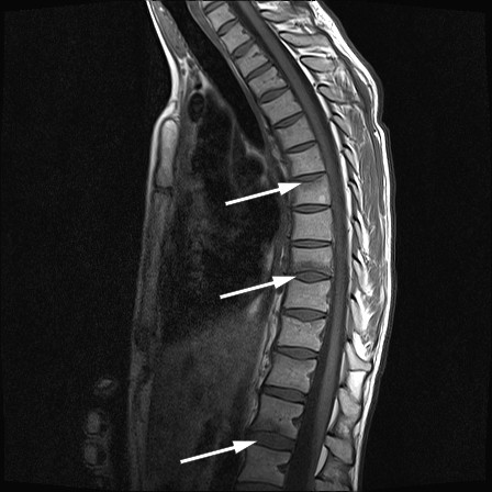 Figure 1 Sagittal T1-weighted magnetic resonance imaging of the thoracic spine showing fractures and bone marrow oedema in…