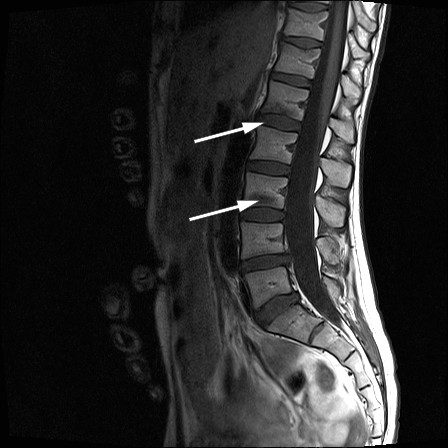 Figure 2 Sagittal T1-weighted magnetic resonance imaging of the lumbar spine showing fractures and bone marrow oedema in the…