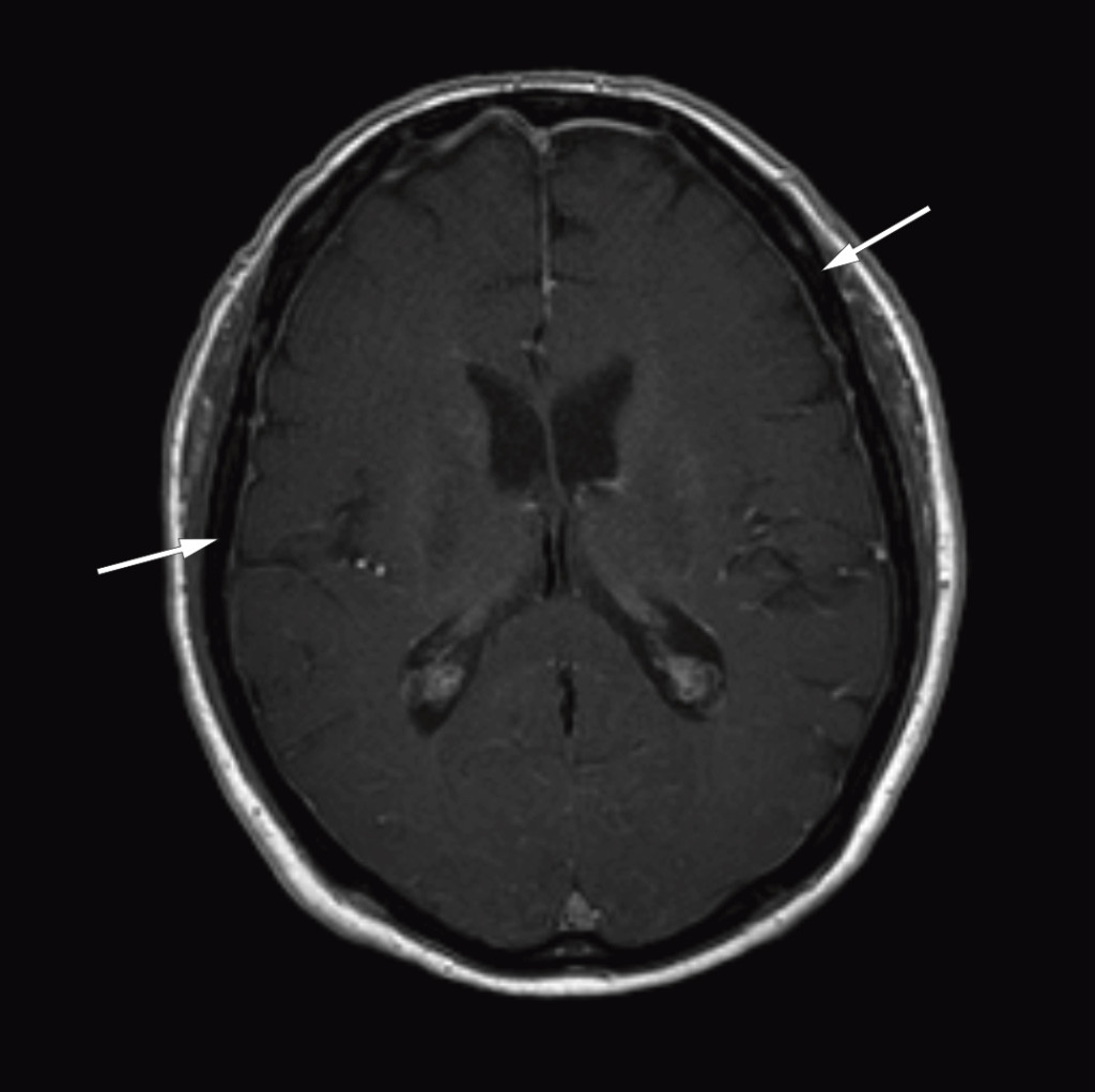 Figure 1 Cerebral MRI after injection of contrast medium (axial section) shows thickened and contrast-enhanced meninges over…