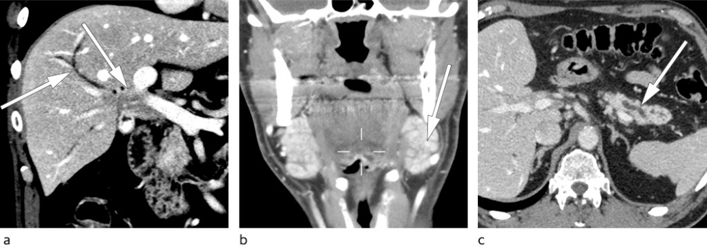 Figure 1 a) CT abdomen showing a mass lesion in the liver hilum with dilated intrahepatic bile ducts. b) CT collum showing…