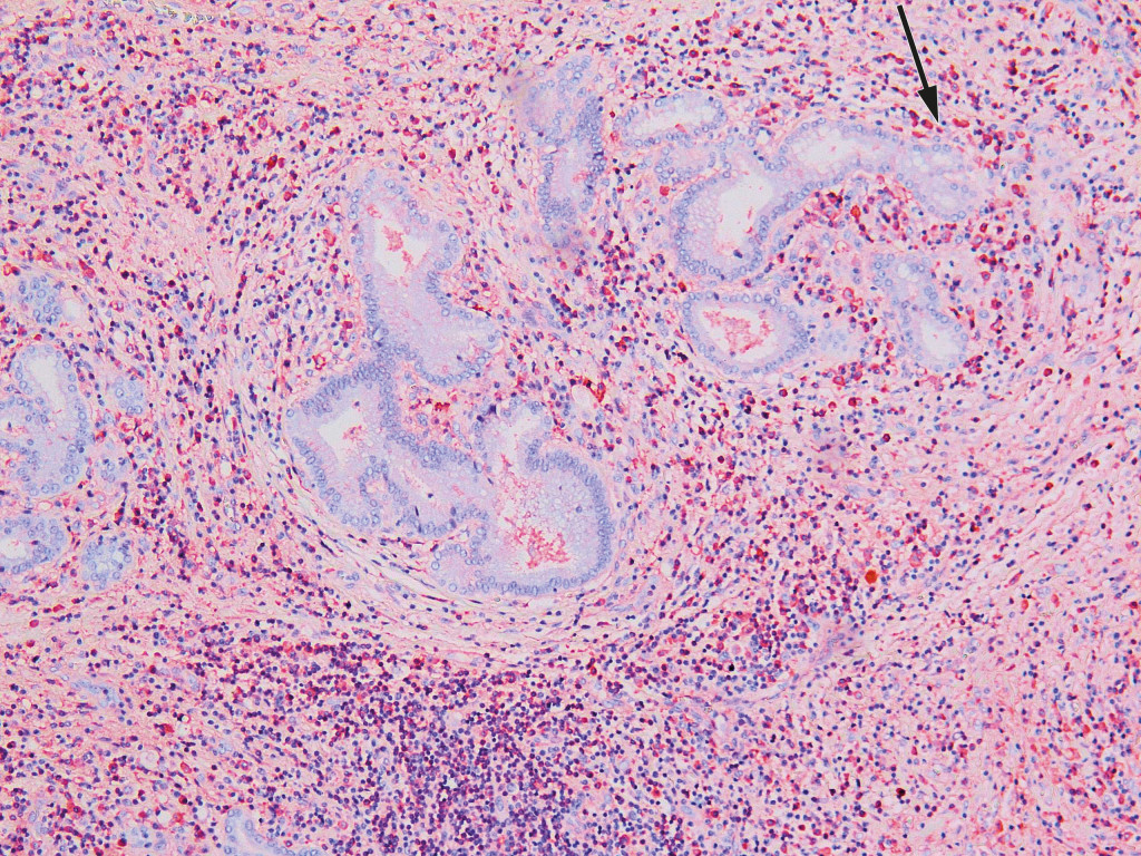 Figure 2 Histological section from liver hilum with lymphoplasmacytic inflammation and abundant eosinophil granulocytes. An…