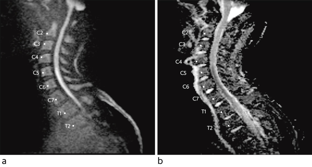 Figure 1 Sagittal diffusion-weighted MRI sequence with b-1 000 image (a) and apparent diffusion coefficient (ADC) map (b)…