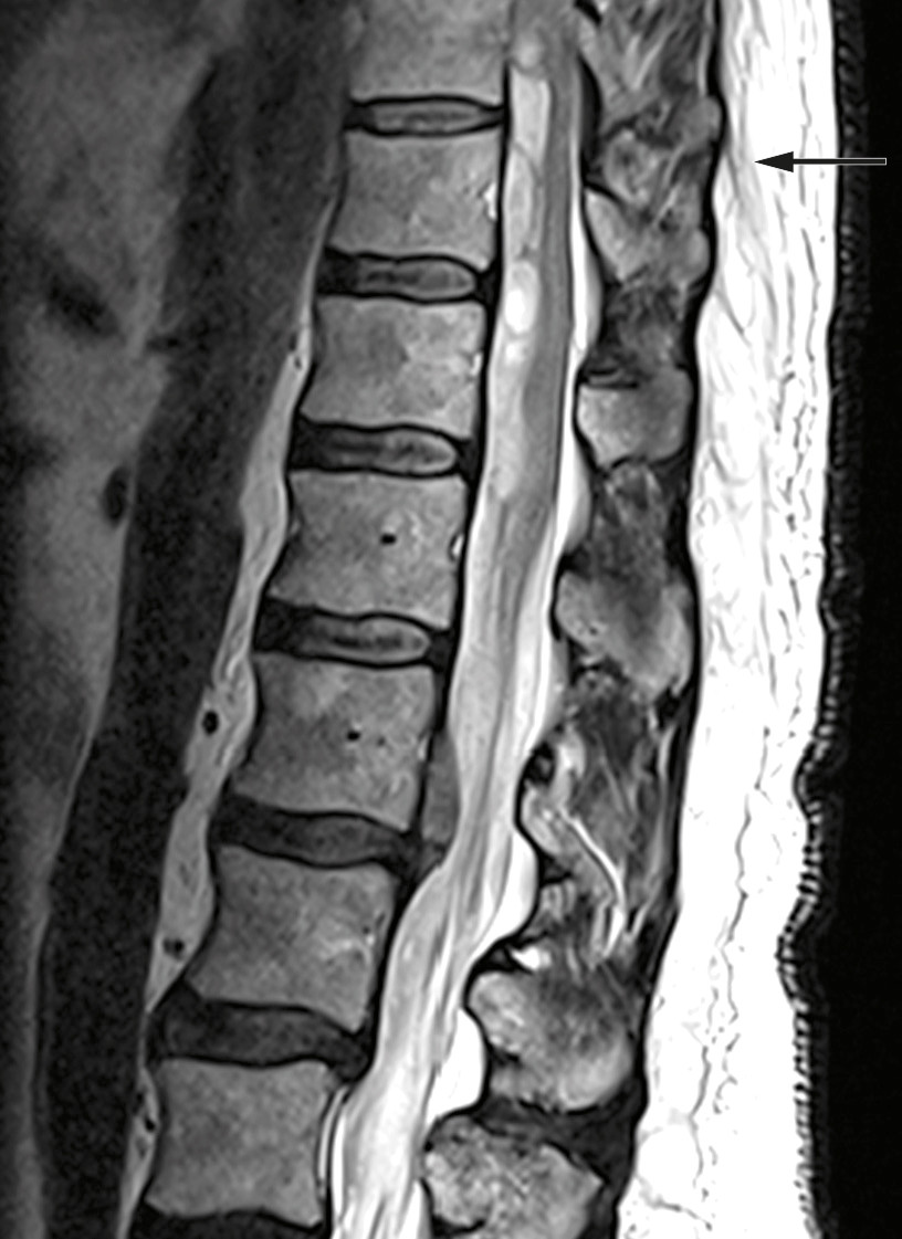 Figure 1 Preoperative MRI: Intraspinal subdural haematoma at levels Th9-L1 and dislocation of the spinal cord and medullary…