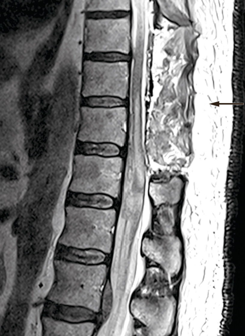 Figure 2 Postoperative MRI: Laminectomy performed at levels Th9–11. MRI shows reduction in volume of the subdural haematoma…