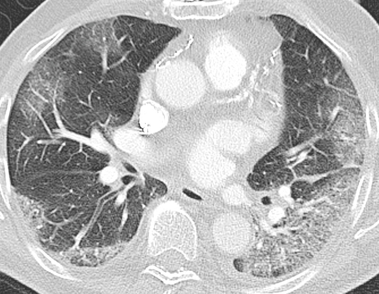 Figure 1 Pulmonary CT angiogram taken on day 5. Axial CT image with lung window shows solid ground-glass opacities in all…