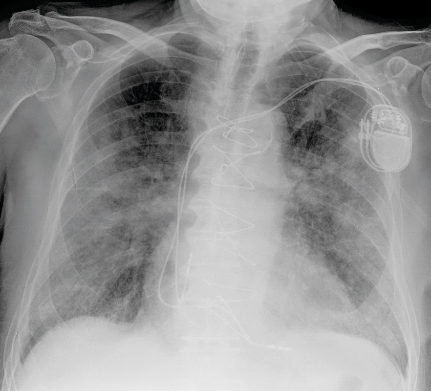 Figure 2 Chest X-ray frontal image taken on day 7 shows extensive opacities bilaterally, both patchy and consolidating. The…
