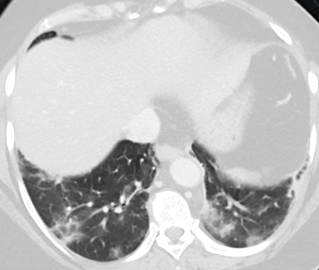 Figure 1 Cross-sectional image of the bases of the lungs as part of the CT examination of the abdomen. The image shows&hellip;