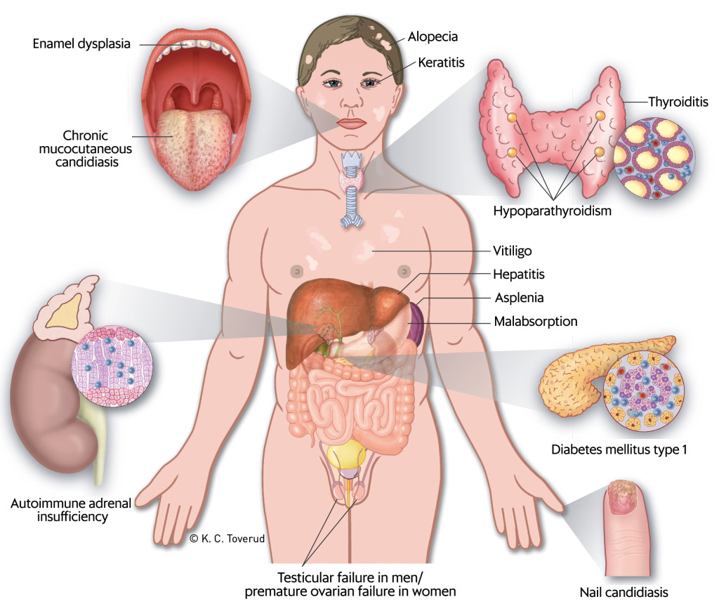 Figure 1 Clinical manifestations that may occur in cases of autoimmune polyendocrine syndrome type 1 (APS-1). The figure has…