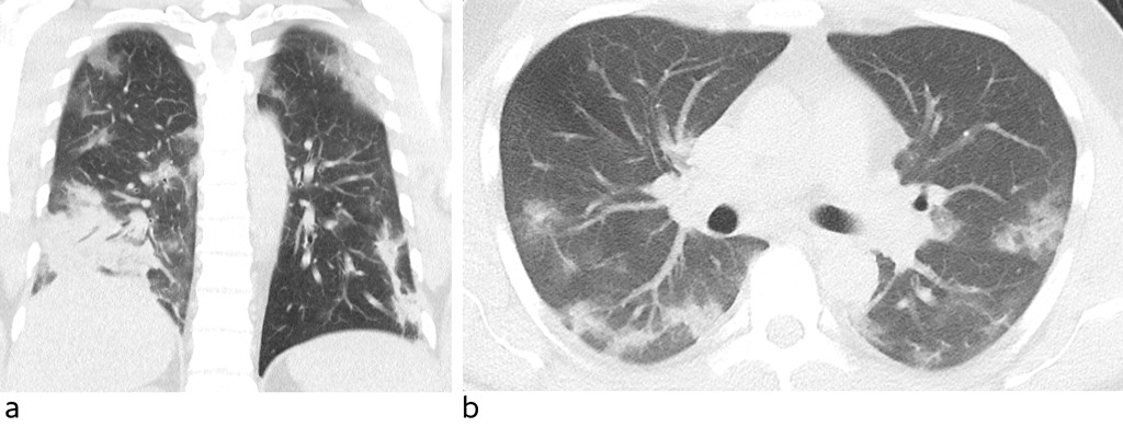 Figure 1 Low-dose CT thorax, coronal section (a) and axial section (b). The images show abundant diffuse ground-glass&hellip;