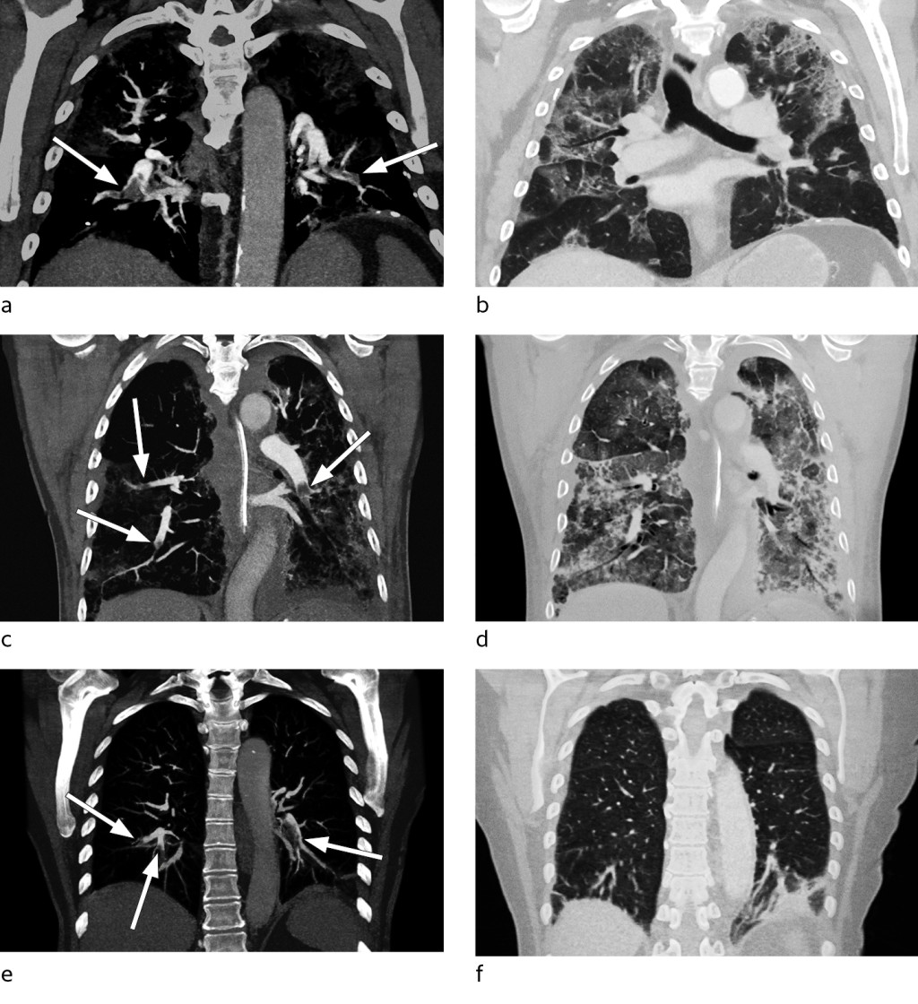 Figure 2 CT pulmonary angiography with coronal maximum intensity projection (MIP) reconstructions. The images show pulmonary…
