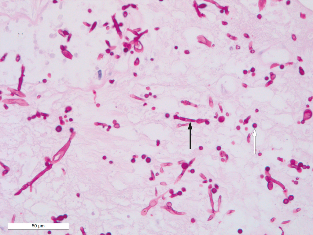 Figure 2 Histological PAS-stained section of tissue from the wound edge on the right knee showing positive results for&hellip;
