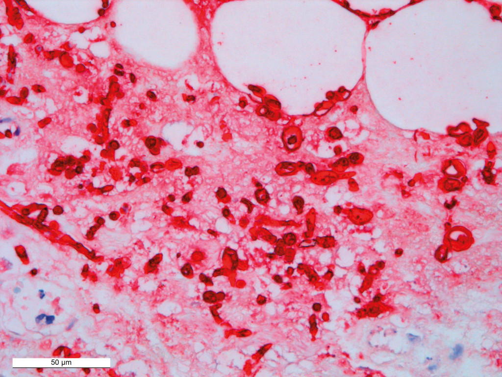 Figure 3 Immunohistochemistry was positive (red) for Candida.