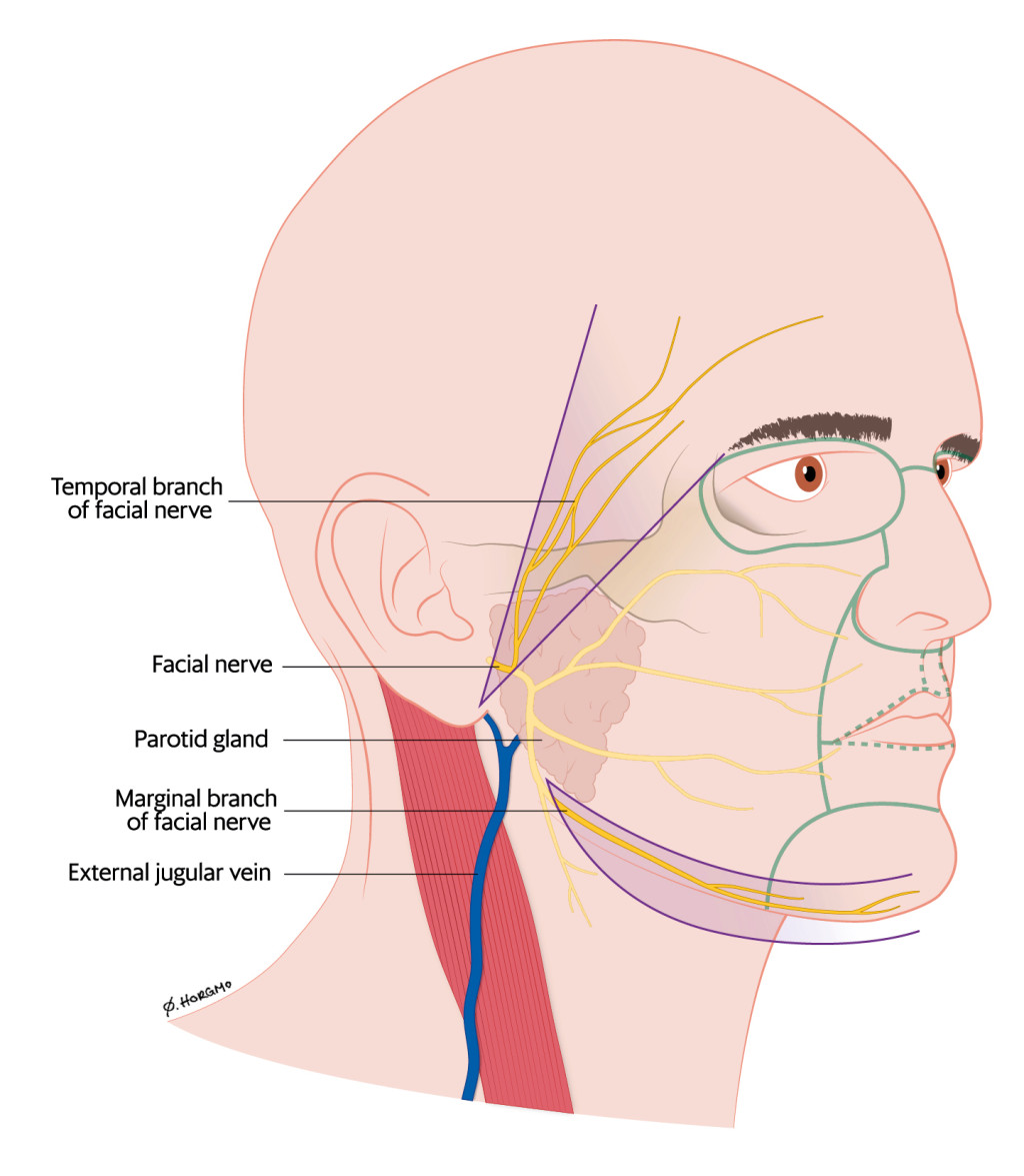 Figure 1 Temporal branch of facial nerve, marginal branch of facial nerve and external jugular vein. The boundaries between…