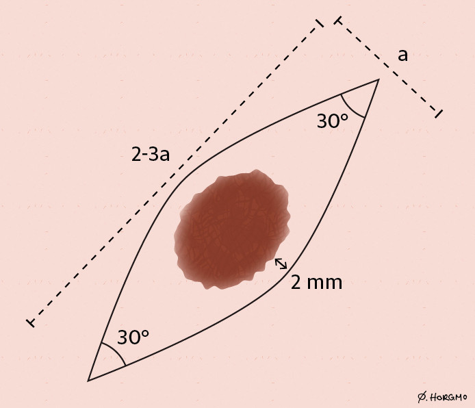 Figure 2 Fusiform markup with macroscopic free margin (2 mm). Ratio 3:1 and acute 30o angles. The 3:1 ratio is not absolute,…