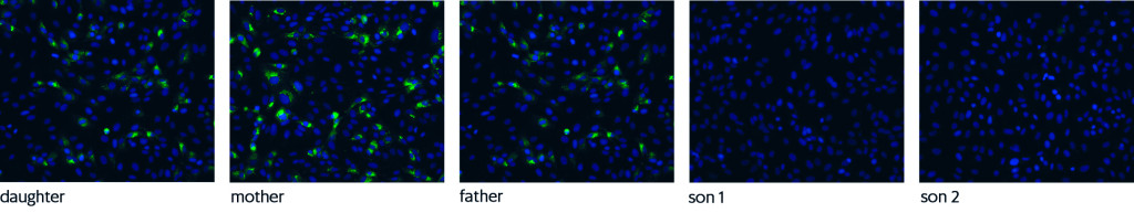 Figure 2 Immunofluorescence staining (IF) of SARS-CoV-2-infected cells with serum from all five family members. SARS-CoV-2…
