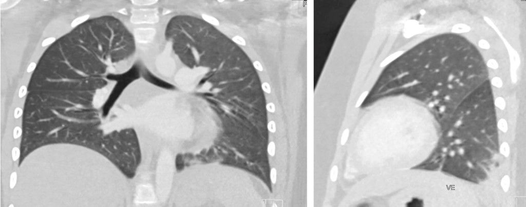 Figure 2 CT thorax with intravenous contrast shows a basilar opacity and modest ground-glass opacities in the left lung, a…