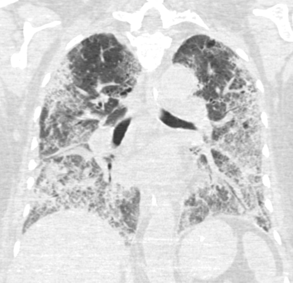 Figure 2 Frontal CT thorax section taken 28 days after onset of symptoms, 17 days after hospitalisation and 14 days after…