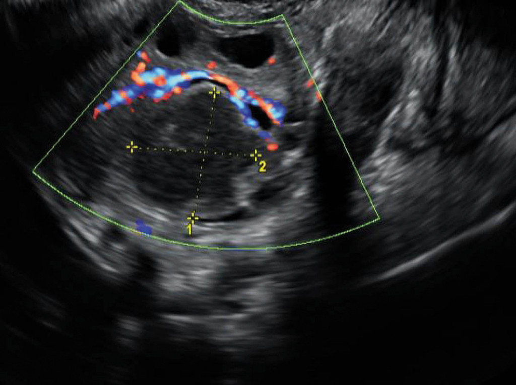 Figure 2 Vaginal ultrasound showed an ovarian cyst measuring 2.5 × 2.4 cm, with hypoechoic content.