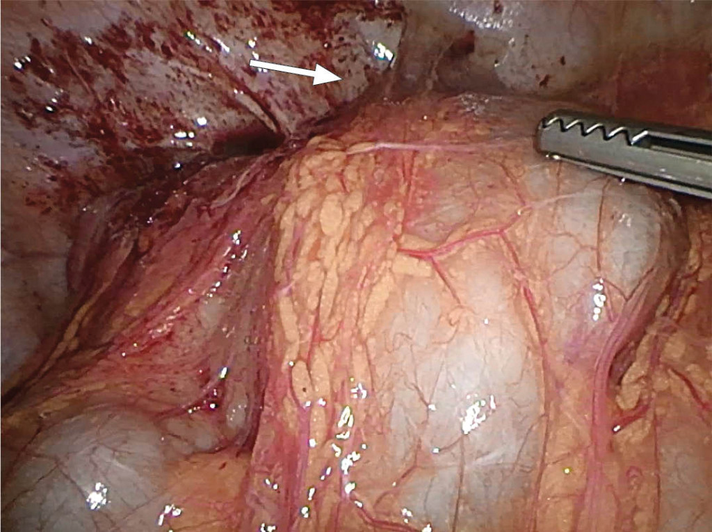 Figure 4 Image from laparoscopy. Lack of access to the lesser pelvis owing to adhesion between the intestines and the…