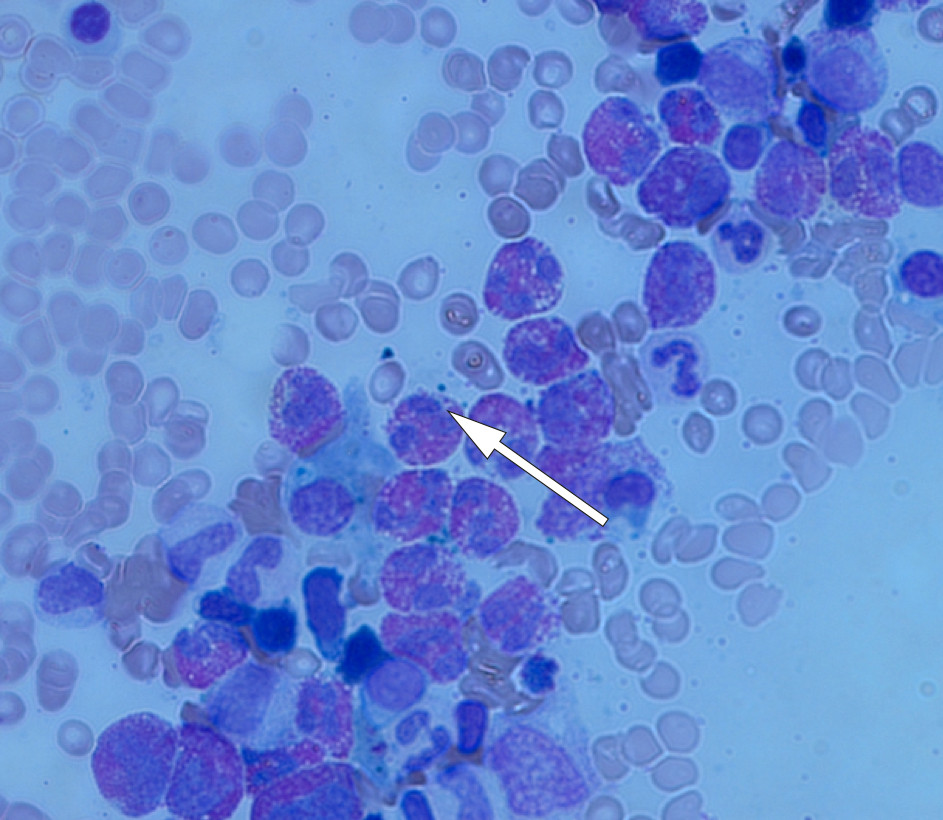 Figure 1 Bone marrow aspirate which shows predominance of eosinophilic granulocytes. Giemsa staining, 100 x enlargement. The…