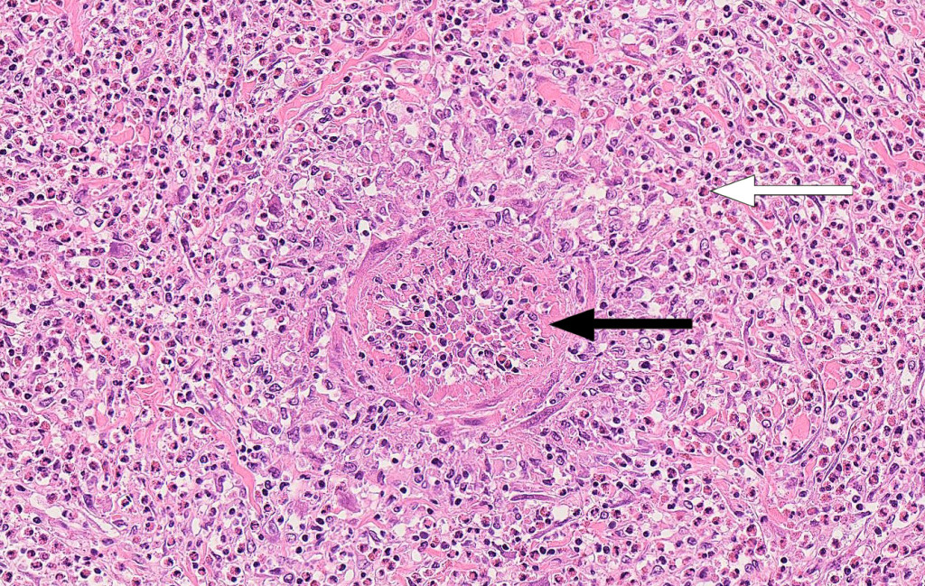 Figure 2 Small liver artery with vasculitis and abundant infiltration of eosinophilic granulocytes. Haematoxylin-eosin…