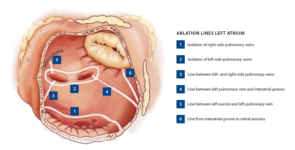 Figure 1 Ablation lines according to the CURE-AF protocol generated with radiofrequency ablation. The figure is reproduced…