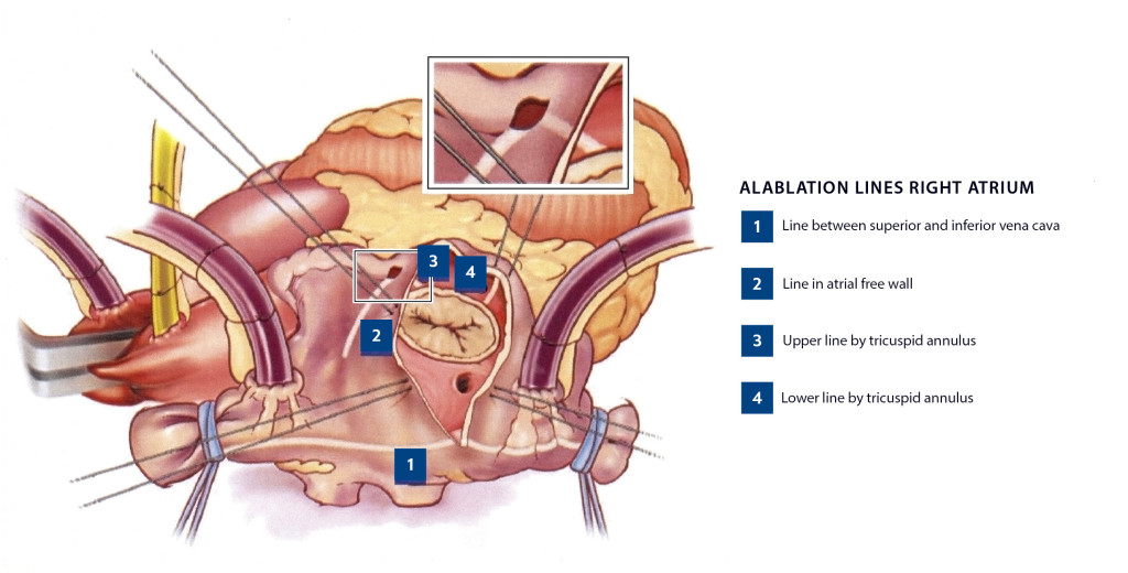 Figure 2 Ablation lines according to the CURE-AF protocol generated by means of radiofrequency ablation. The figure is…