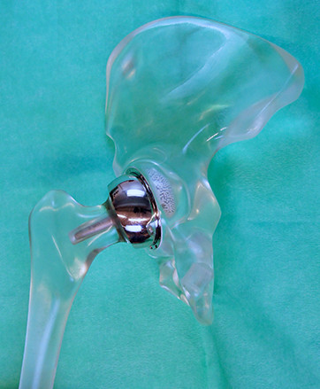 Figure 1 A Birmingham hip resurfacing prosthesis (Smith and Nephew, Warwick, England), implanted here in a hip model, has…